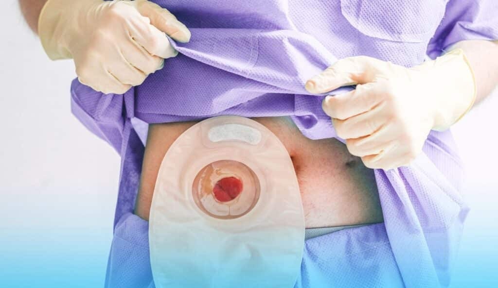 stoma care 1024x683